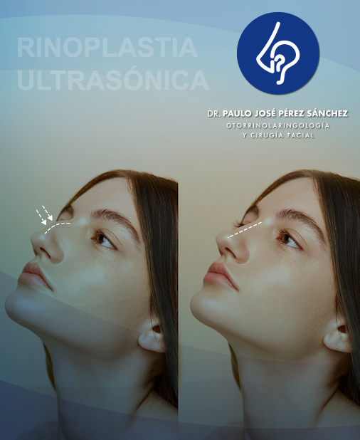 Rinoplastia Ultrasonica Villahermosa